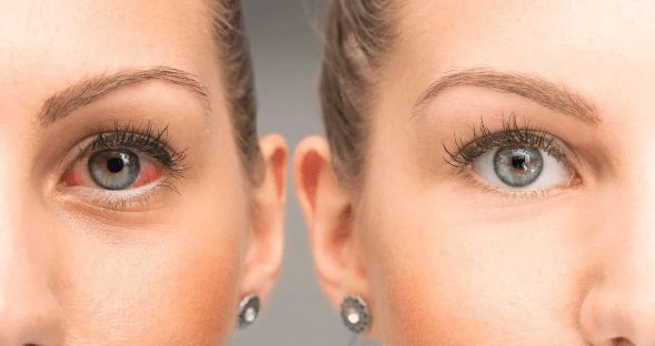 Does Cbd Make Your Eyes Red